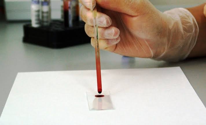 Estudio revela análisis de sangre que mejora la detección del cáncer de próstata agresivo