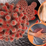 Costa Rica confirma 14 casos de hepatitis A y contaminación en sistema de agua