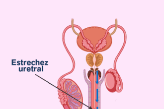 Estrechez uretral: cómo afecta la calidad de vida y qué señales no deben ignorarse