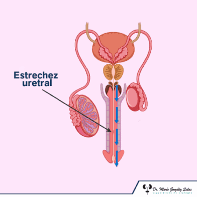 Estrechez uretral: cómo afecta la calidad de vida y qué señales no deben ignorarse