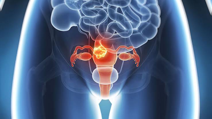 Cáncer ginecológico: las importantes señales que las mujeres no deben ignorar